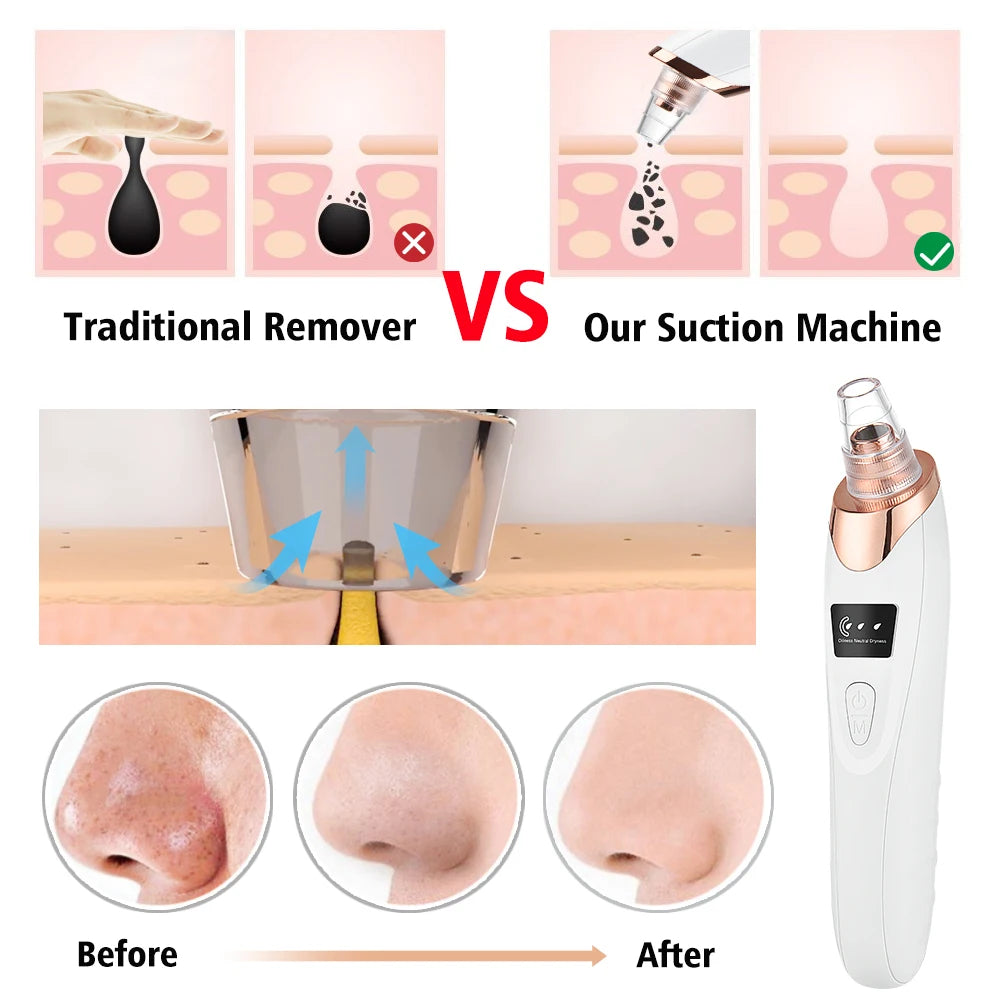 Professional Blackhead Remover Machine – 5-in-1 Electric Pore Vacuum Extractor for Deep Facial Cleansing, Acne & Whitehead Removal